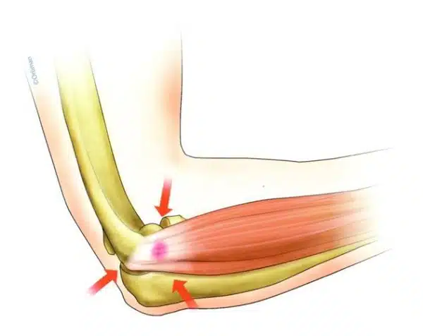 Épicondylite les traitements contre la douleur au coude
